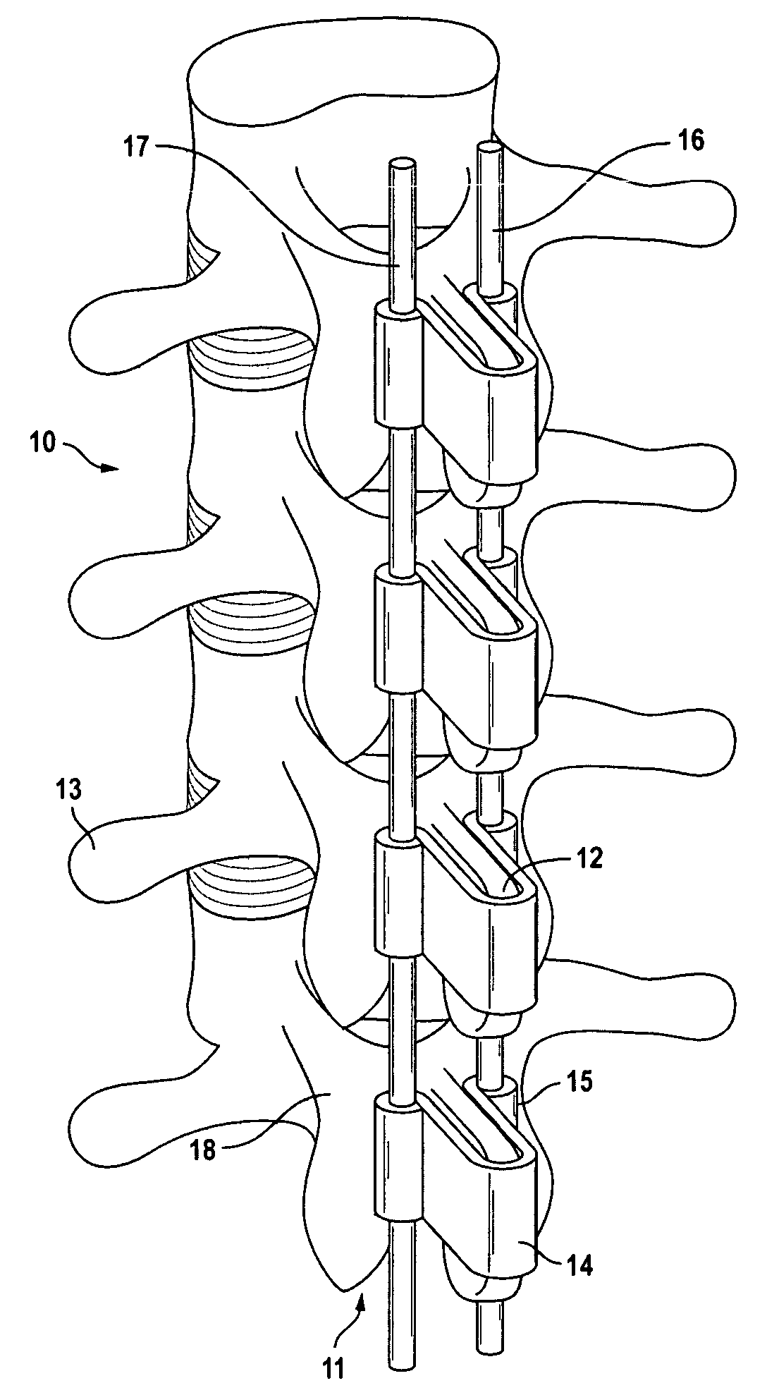 Orthosis to correct spinal deformities