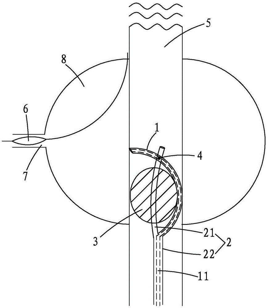 Reversible laser balloon catheter and method for applying same