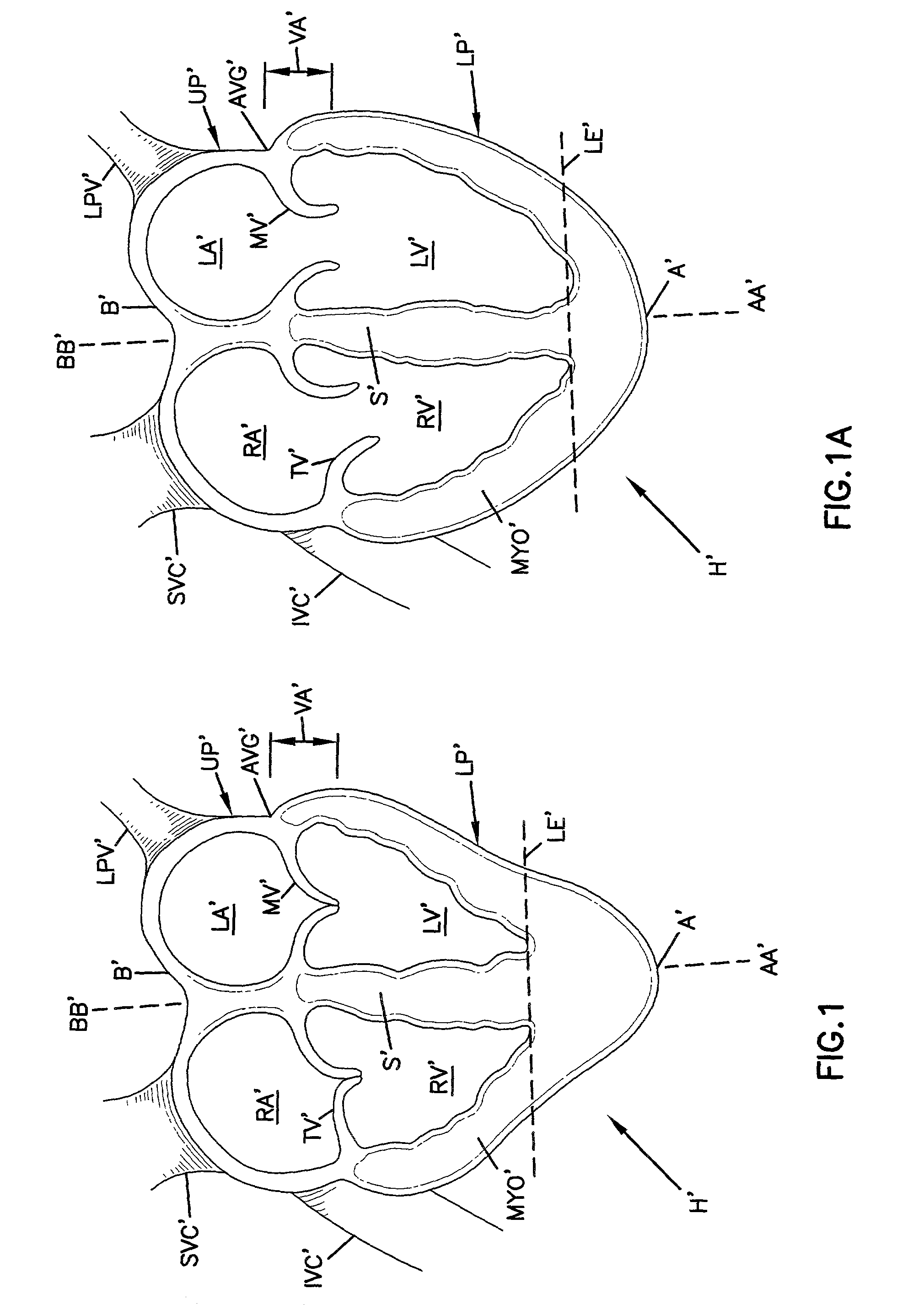 Cardiac support devices and methods of producing same