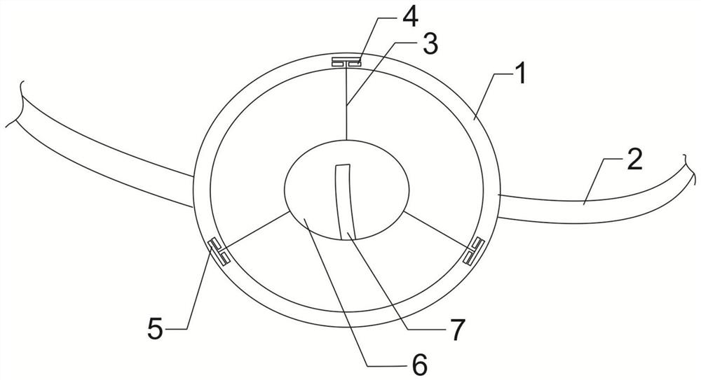 An embedded stoma device