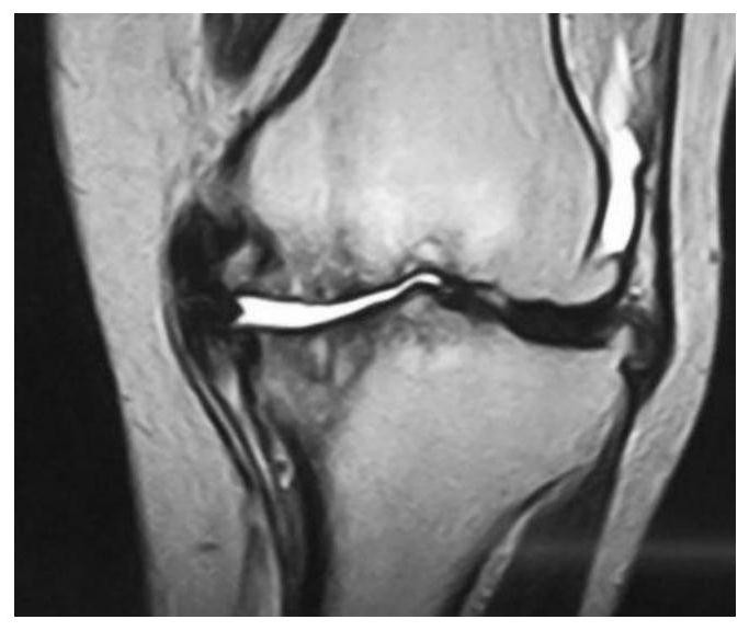 MRI classification image processing system and method for knee osteoarthritis, and terminal