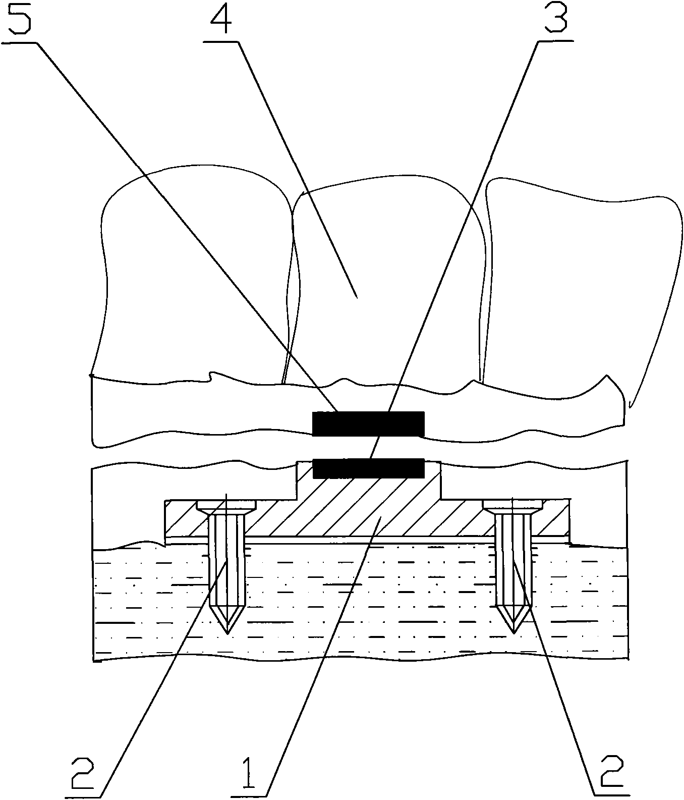 Micro titanium plate magnetic attachment