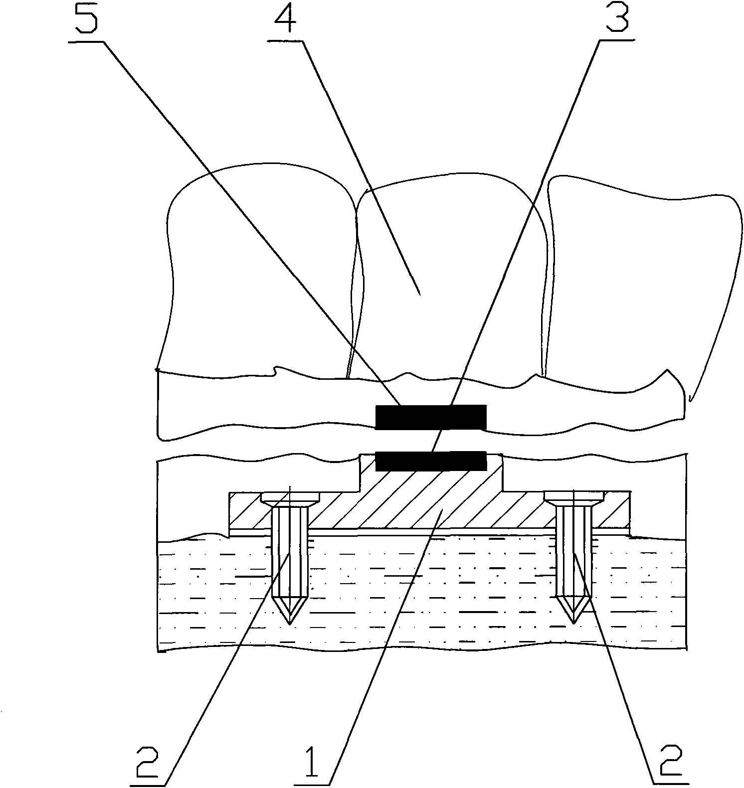 Micro titanium plate magnetic attachment