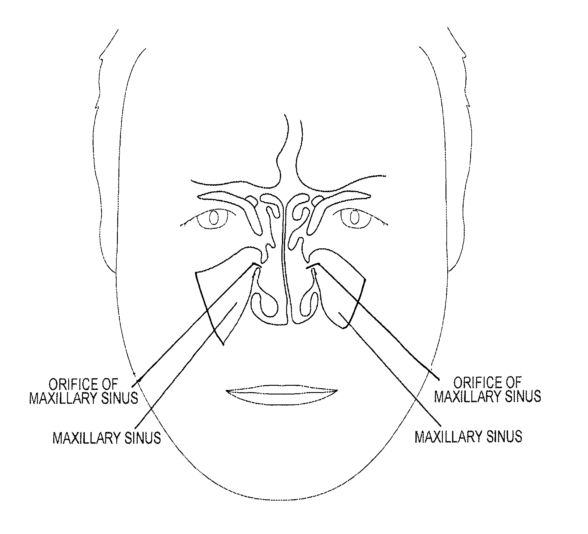 Device and method for delivering therapeutic substances to the maxillary sinus of a patient