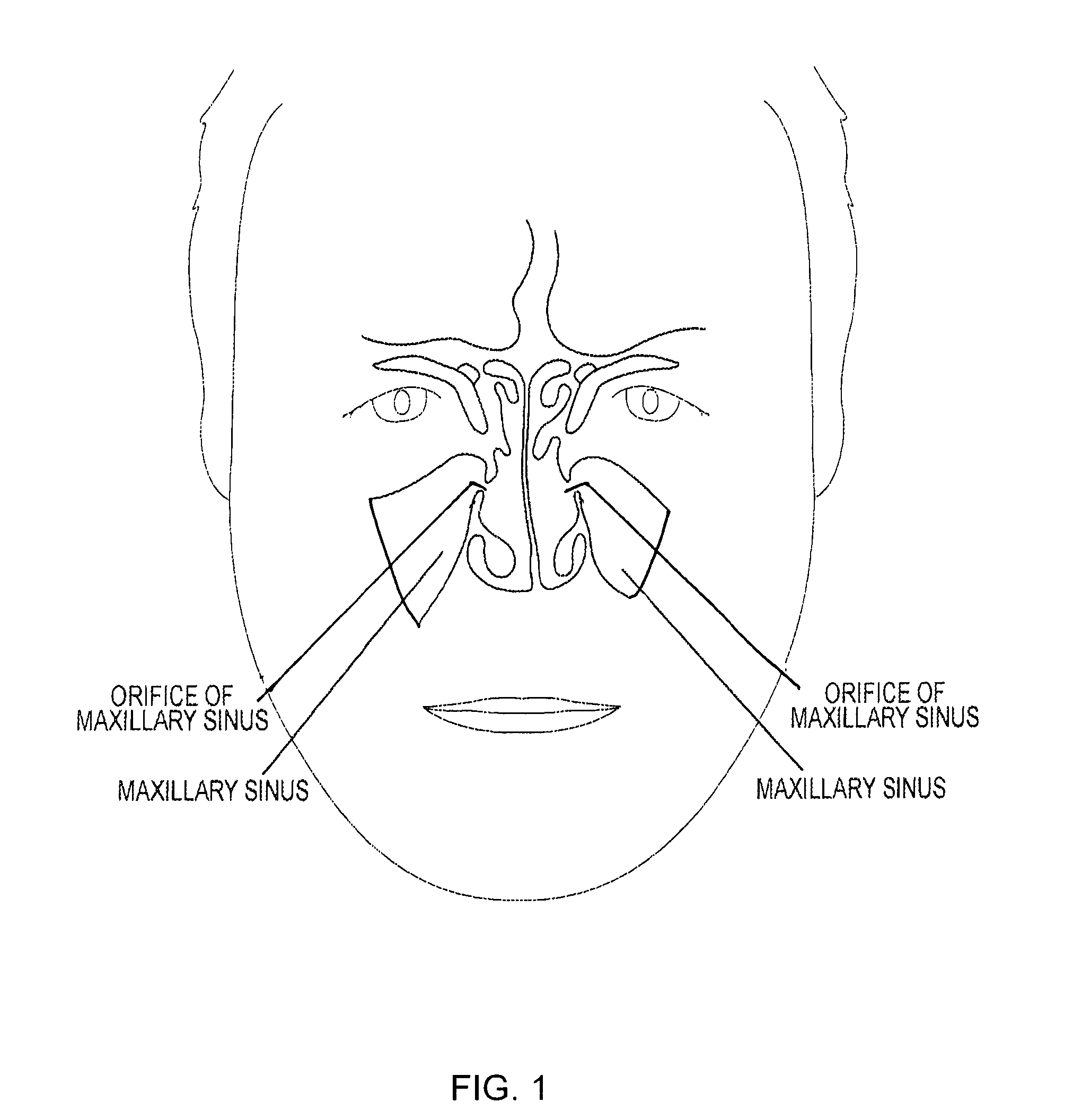 Device and method for delivering therapeutic substances to the maxillary sinus of a patient