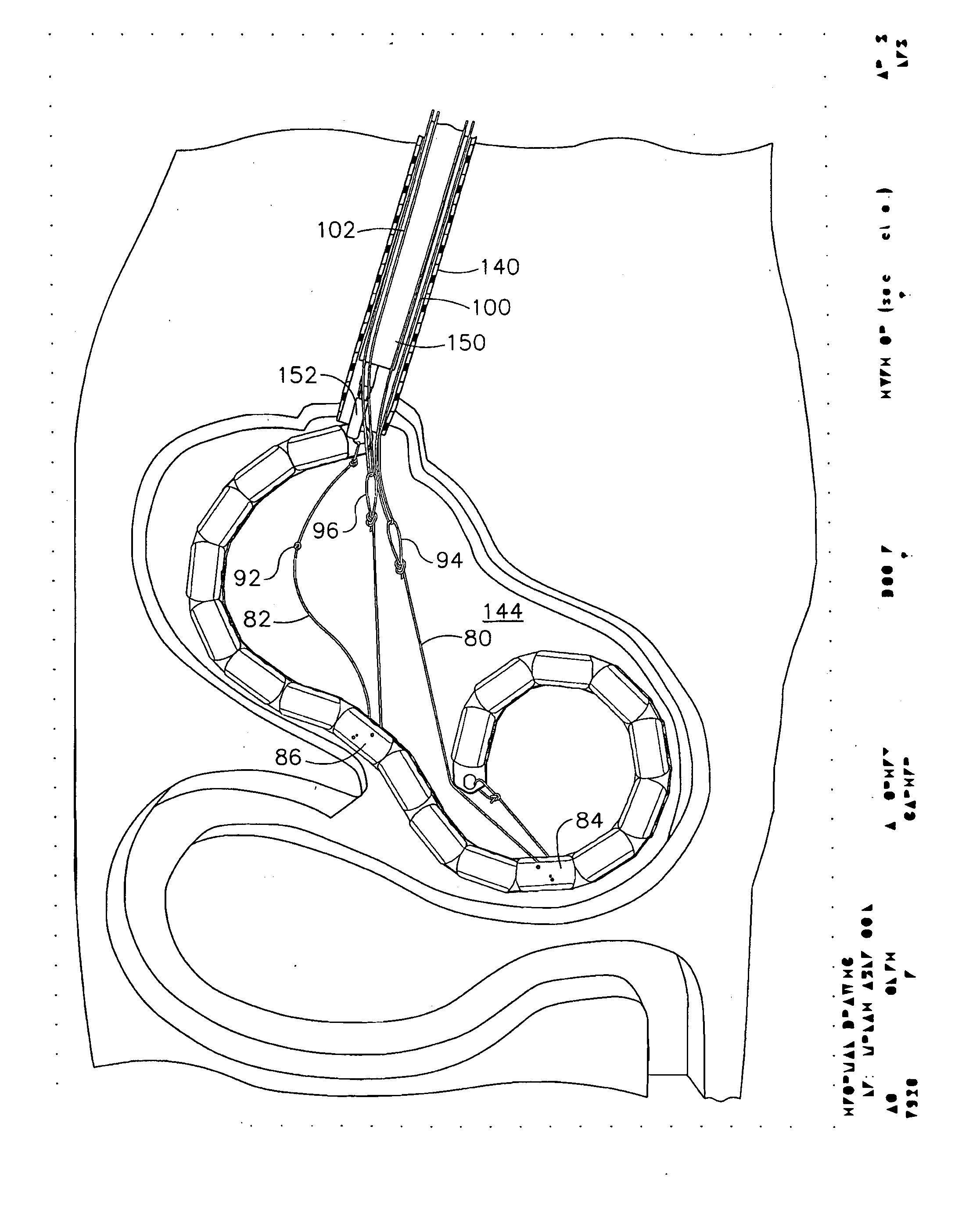 Implantable device for the treatment of obesity