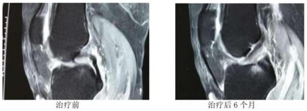 Preparation method and application of pharmaceutical composition for treating knee degenerative osteoarthritis