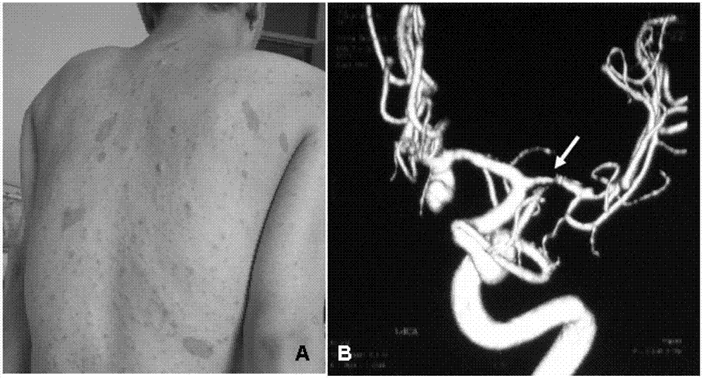 I type neurofibroma NF1 gene mutation nucleotide sequence related to cerebrovascular stenosis and application thereof