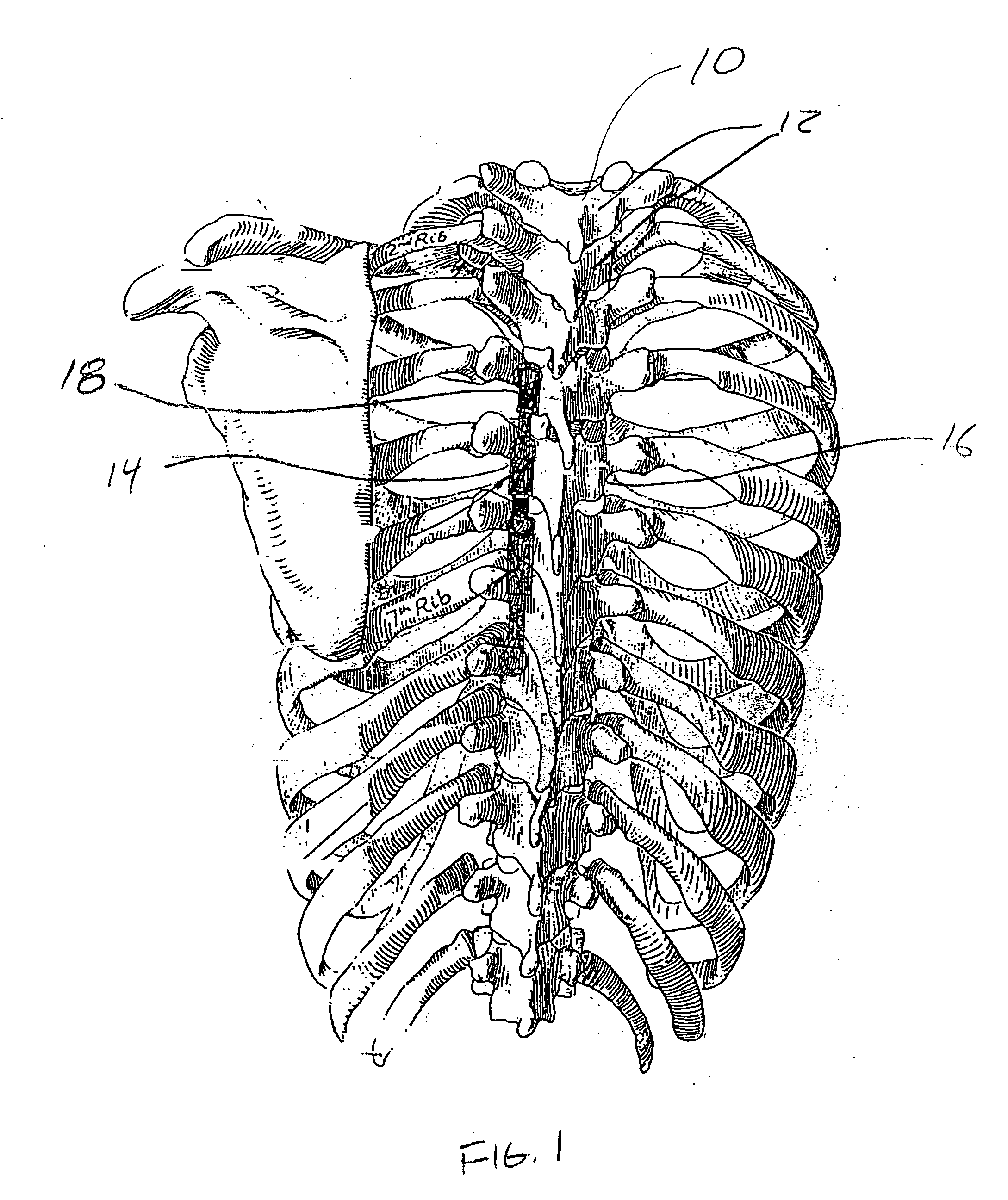 Apparatus and method for concave scoliosis expansion