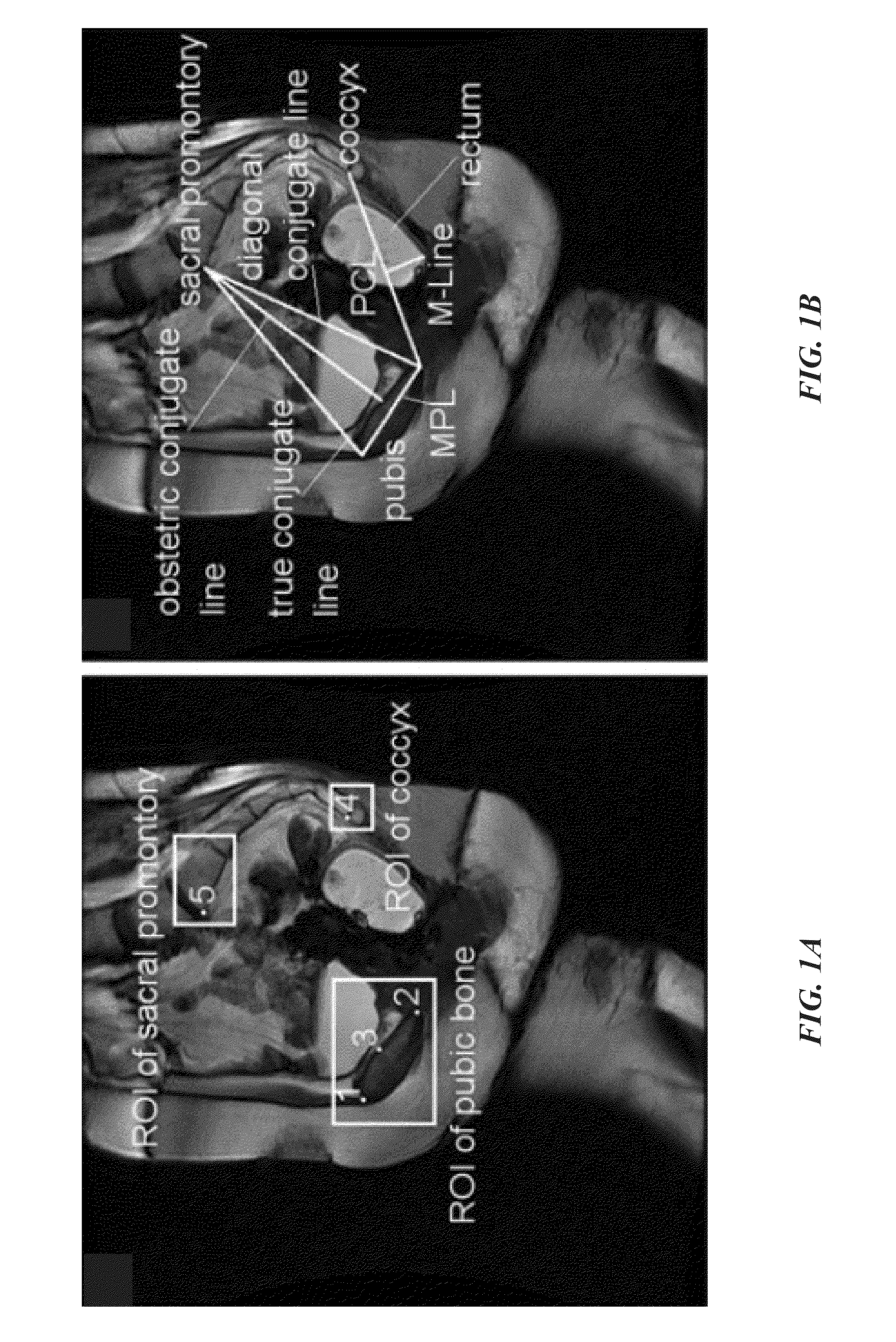 Image-based automated measurement model to predict pelvic organ prolapse