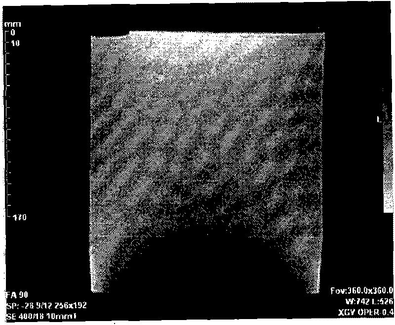 Radio-frequency coil structure applied to low-magnetic field resonance imaging in thermal-ablation therapy