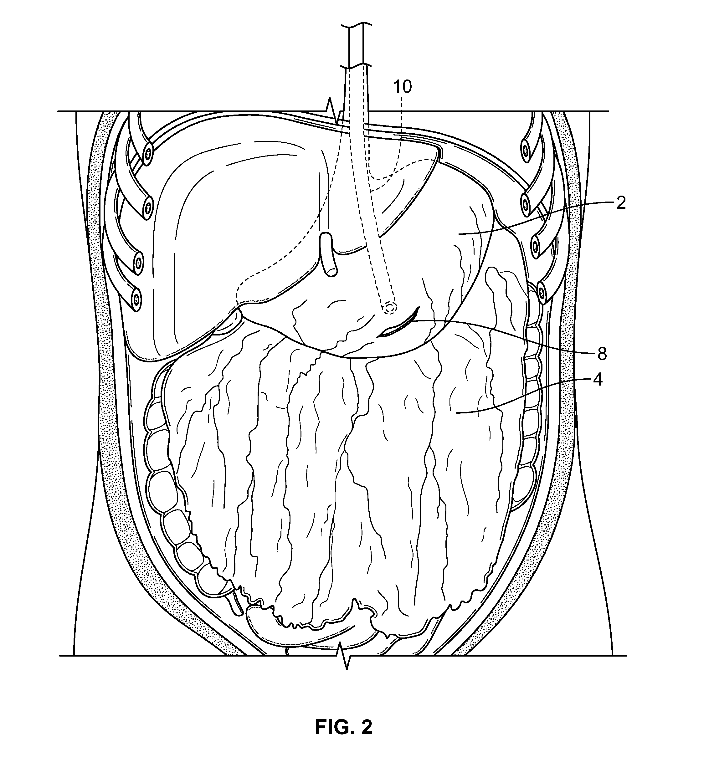 Methods and devices for removing omental tissue