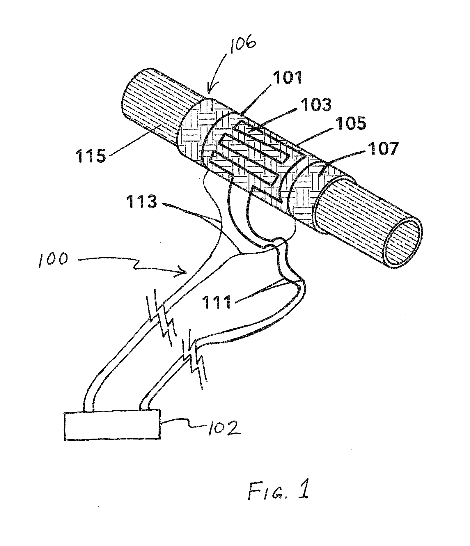 Perivascular Electroporation Device and Method for Extending Vascular Patency