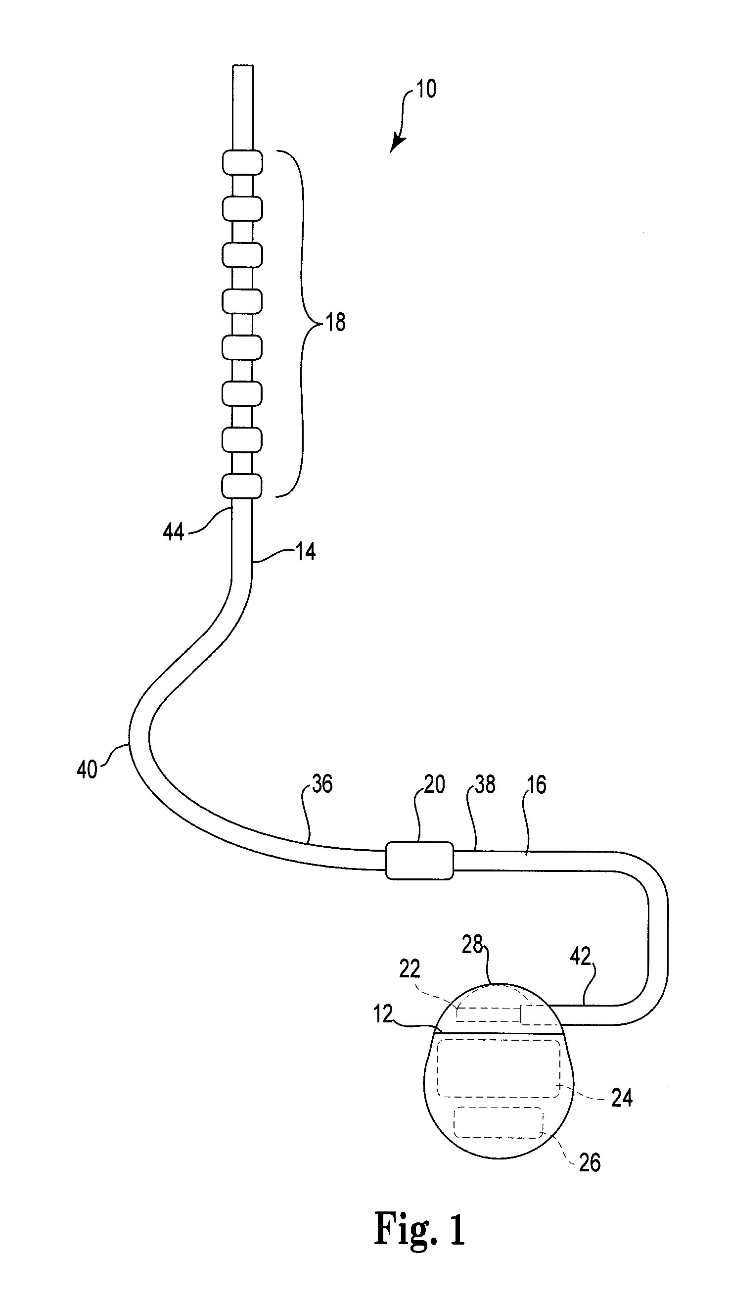 Implantable lead with braided conductors