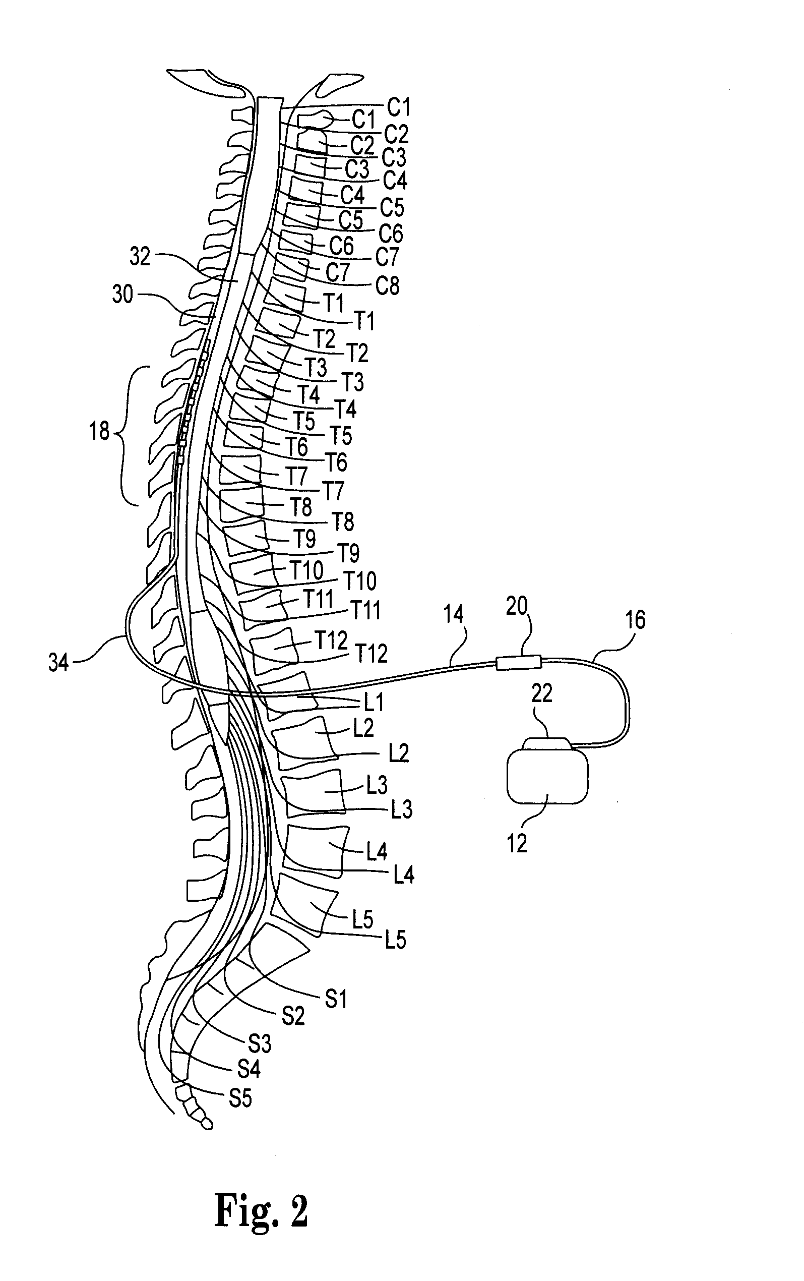 Implantable lead with braided conductors