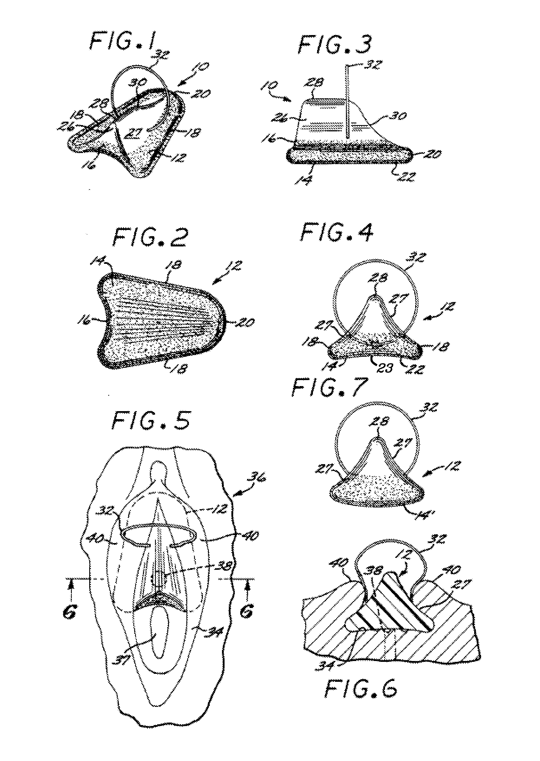 Systems and methods for incontinence control