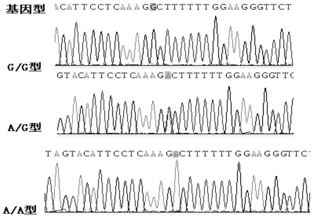 Combined application and method for detecting GRK4 mutant, systolic pressure variation and urine sodium excretion rate