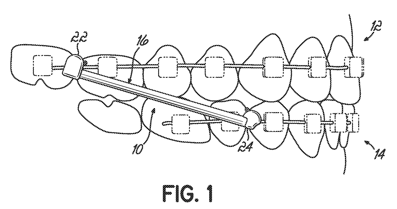 Orthodontic device and method for treating malocclusions