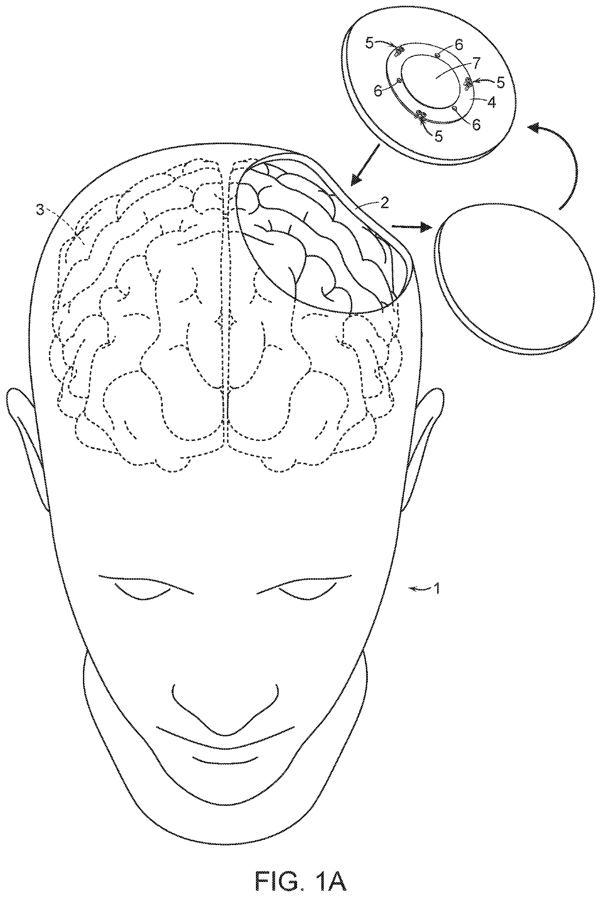 Modulated ultra-sound compatible artificial cranial prosthesis