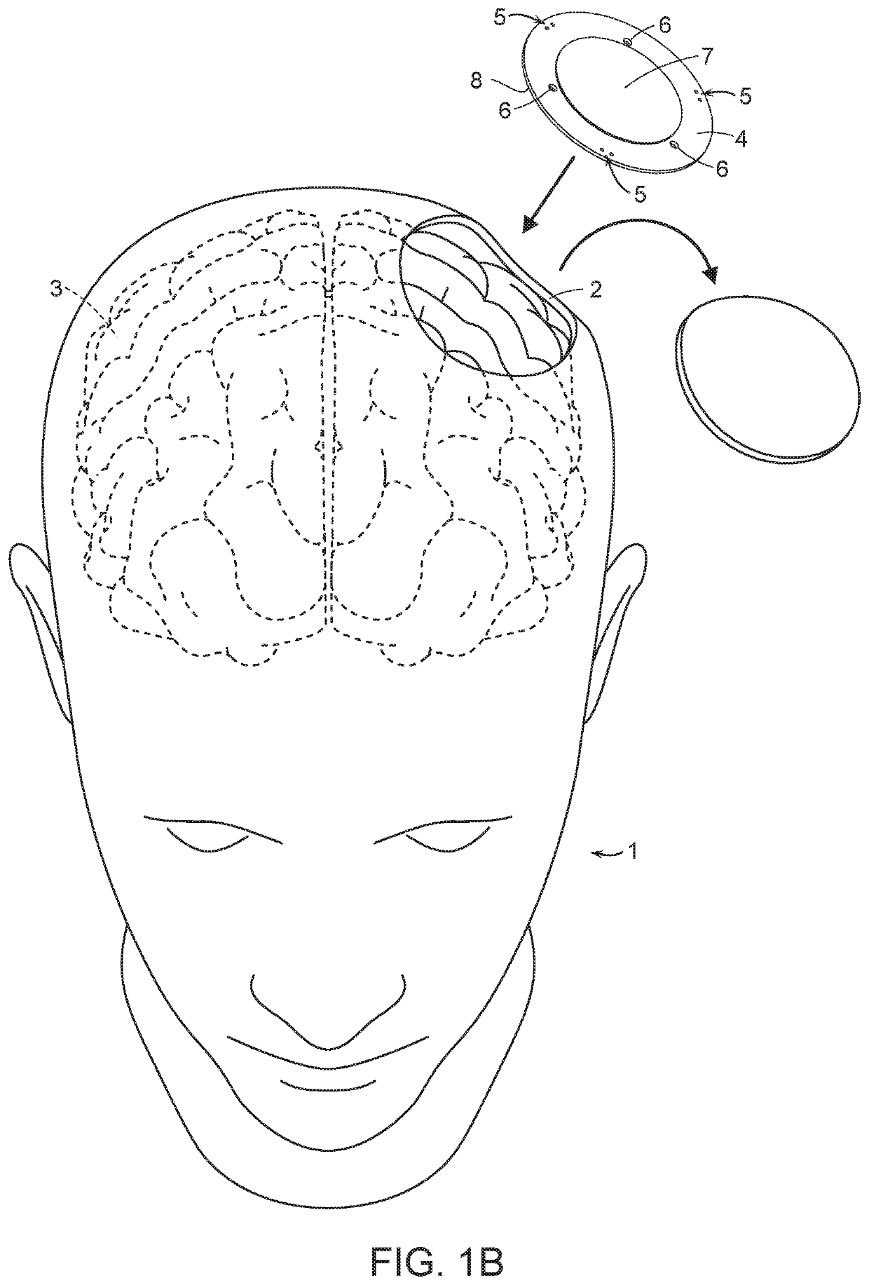 Modulated ultra-sound compatible artificial cranial prosthesis