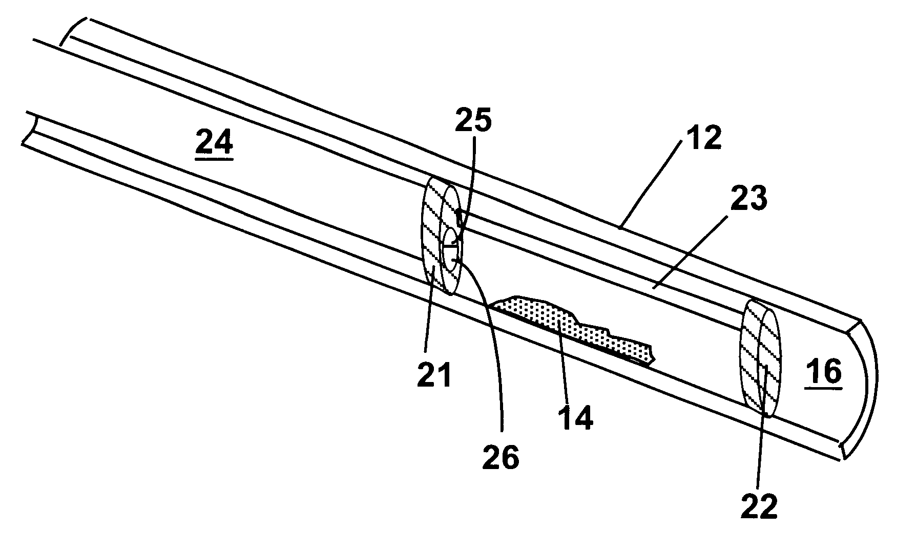 Methods and devices for reducing the mineral content of vascular calcified lesions