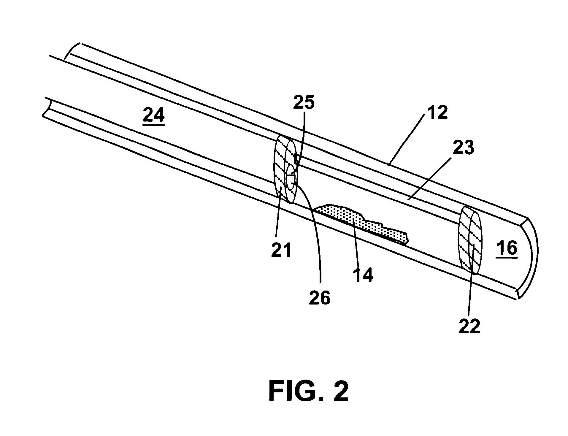 Methods and devices for reducing the mineral content of vascular calcified lesions