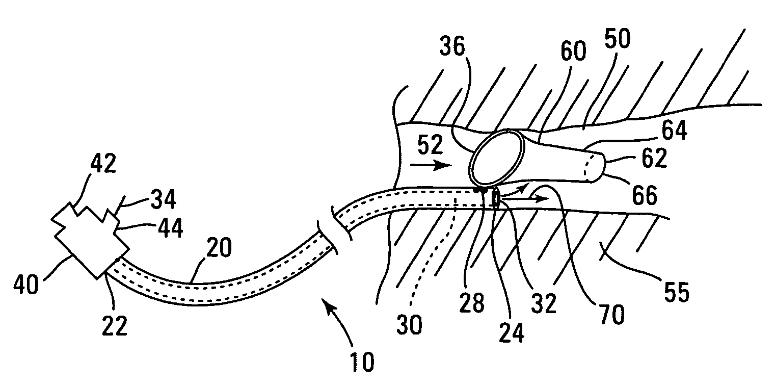 Local perfusion device