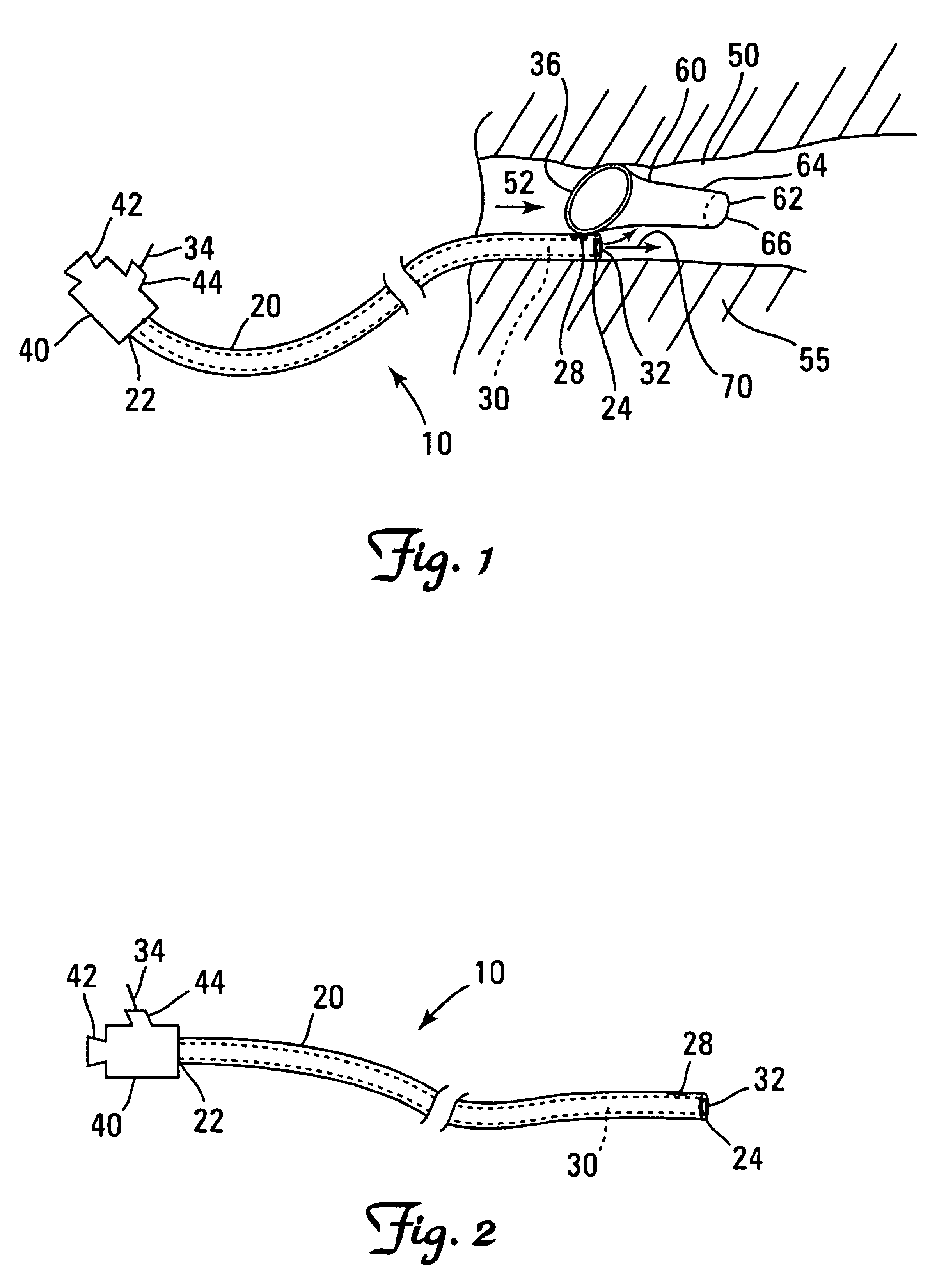 Local perfusion device