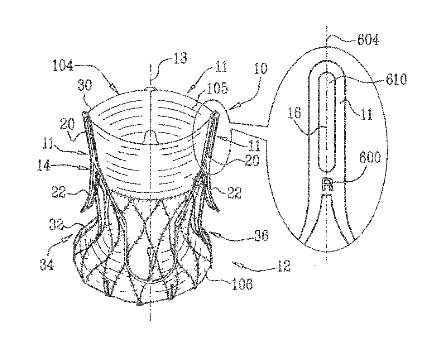 Prosthetic heart valve having identifiers for aiding in radiographic positioning