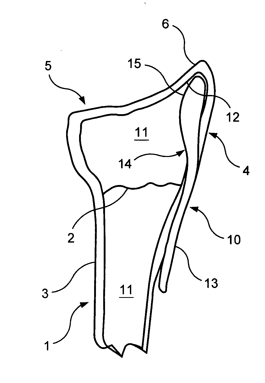 Intramedullary implant for fracture fixation