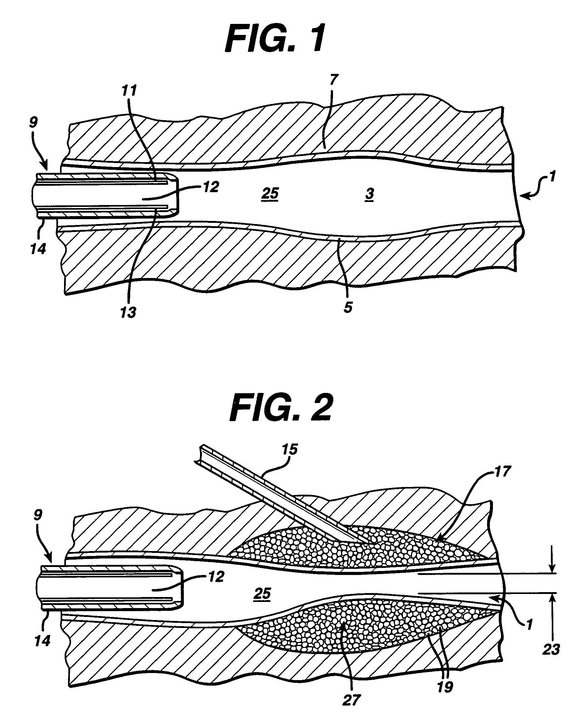 Swollen hydrogel for sphincter augmentation