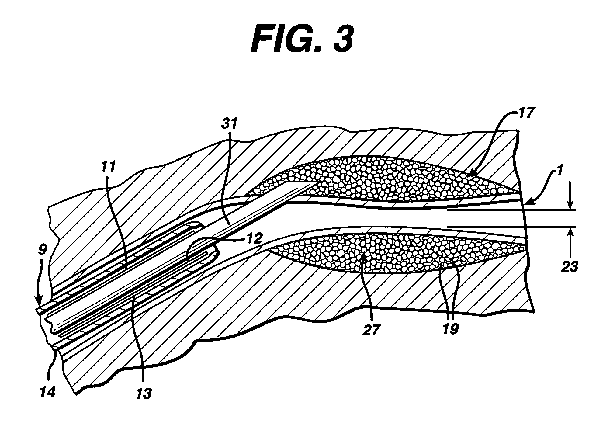 Swollen hydrogel for sphincter augmentation