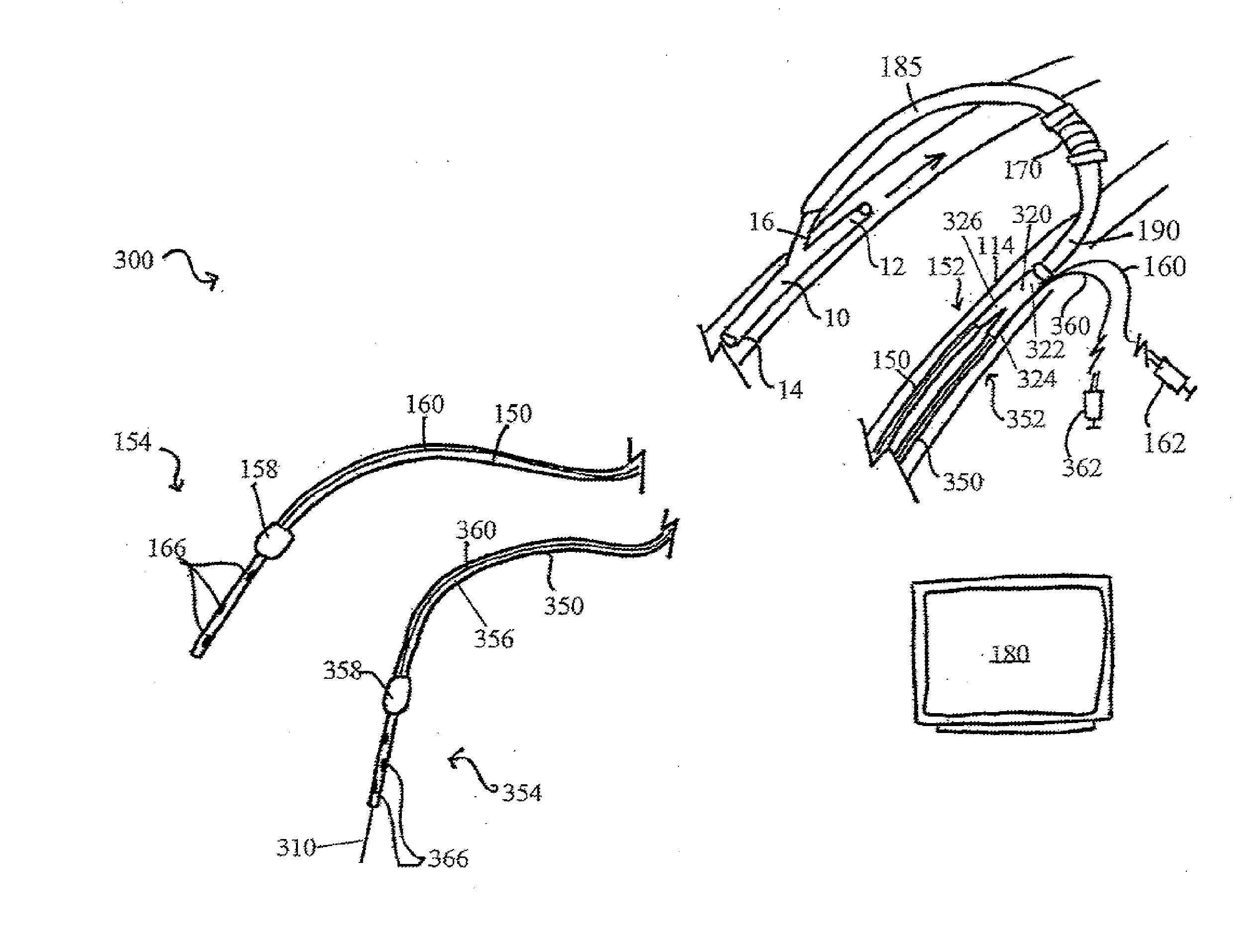 Systems, devices, and methods for organ retroperfusion along with regional mild hypothermia