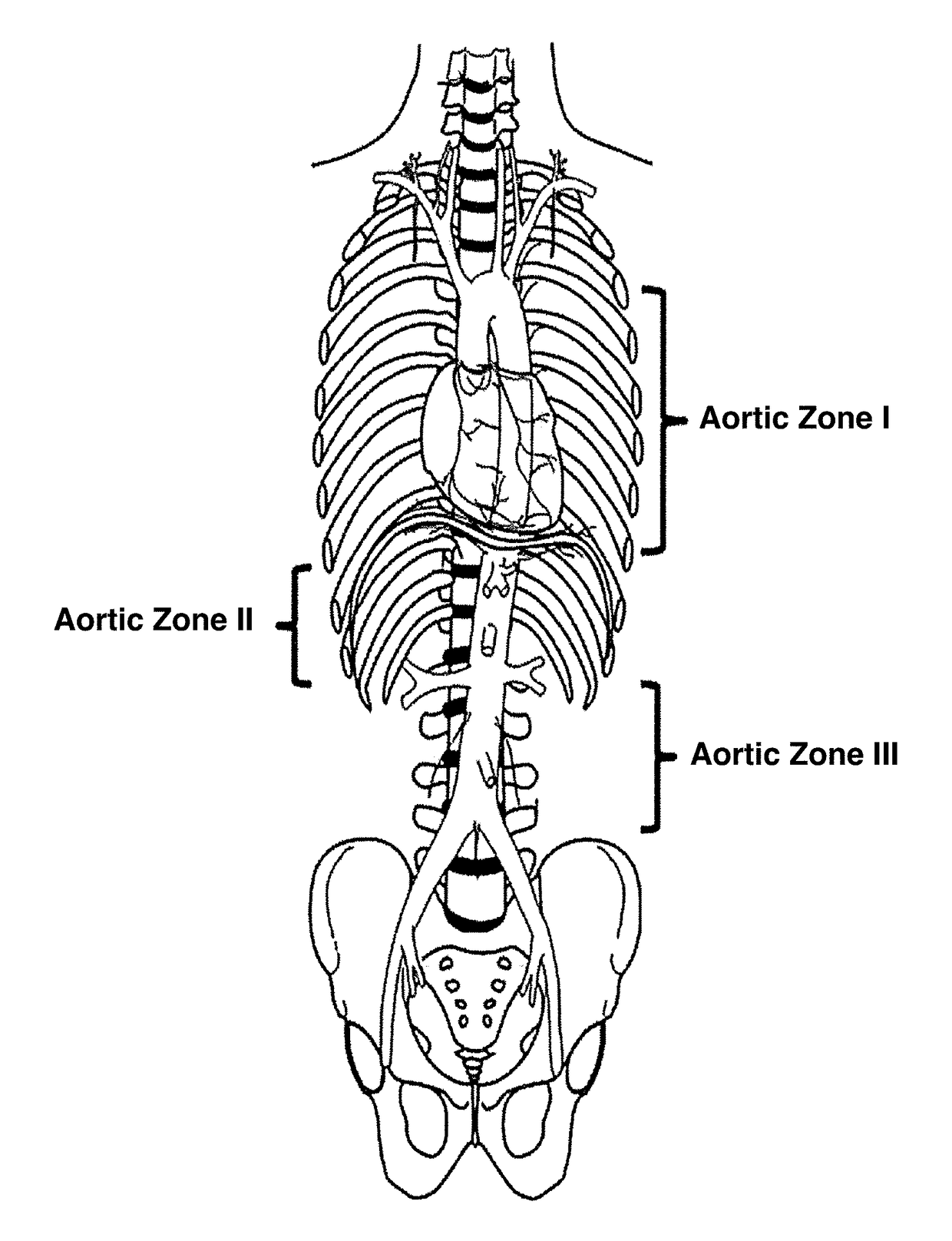 Central Pressurized Cadaver Model