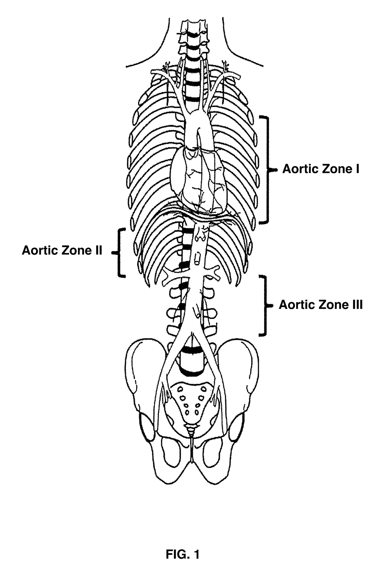 Central Pressurized Cadaver Model