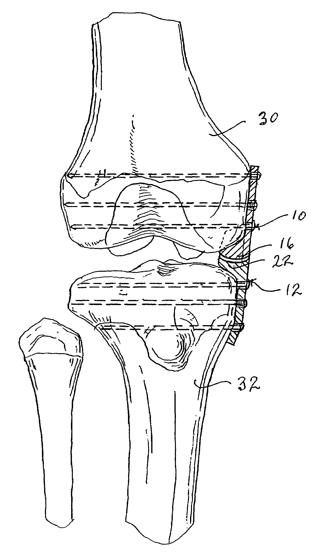 Internal brace for distraction arthroplasty