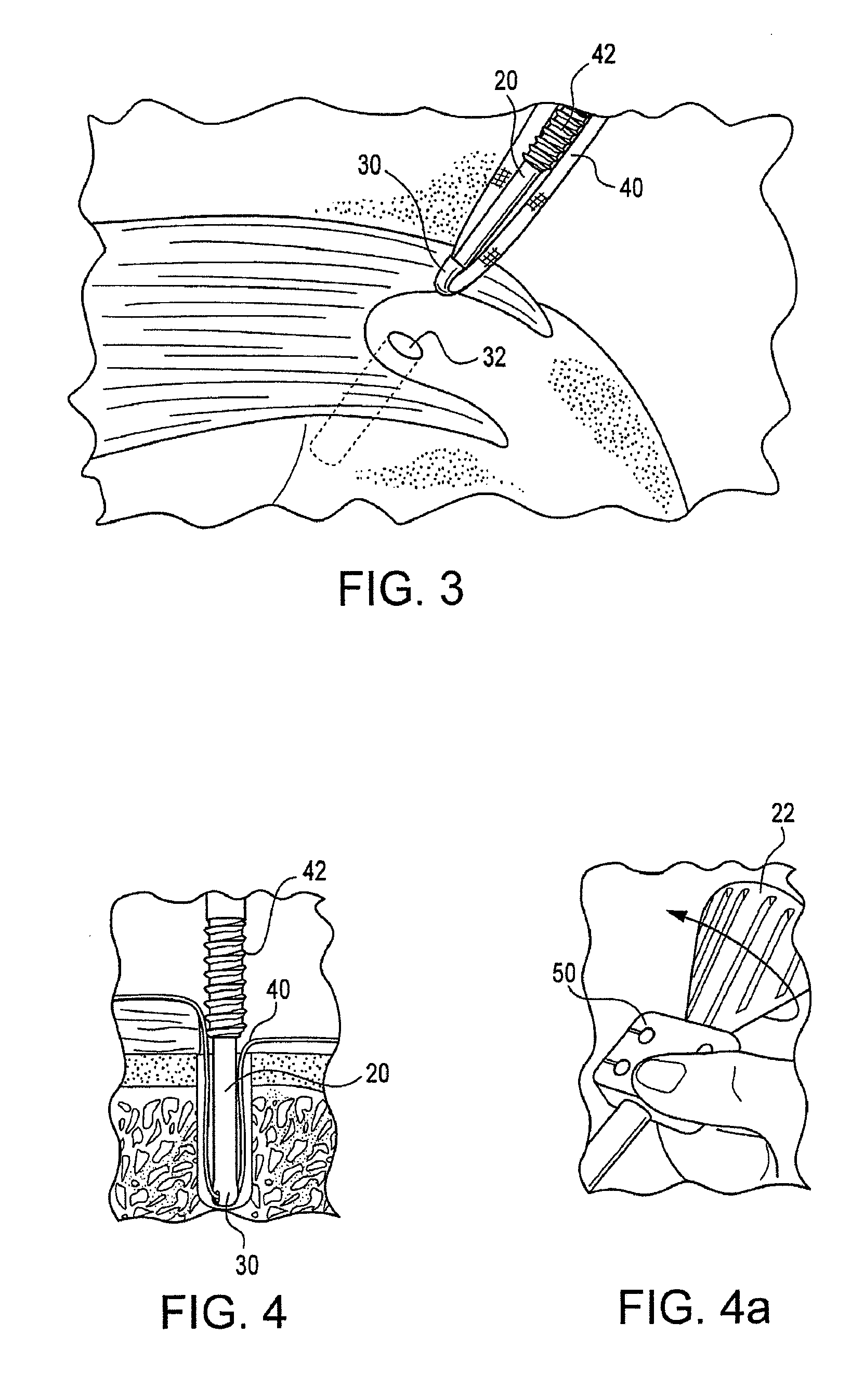 Fenestrated swivel anchor for knotless fixation of tissue