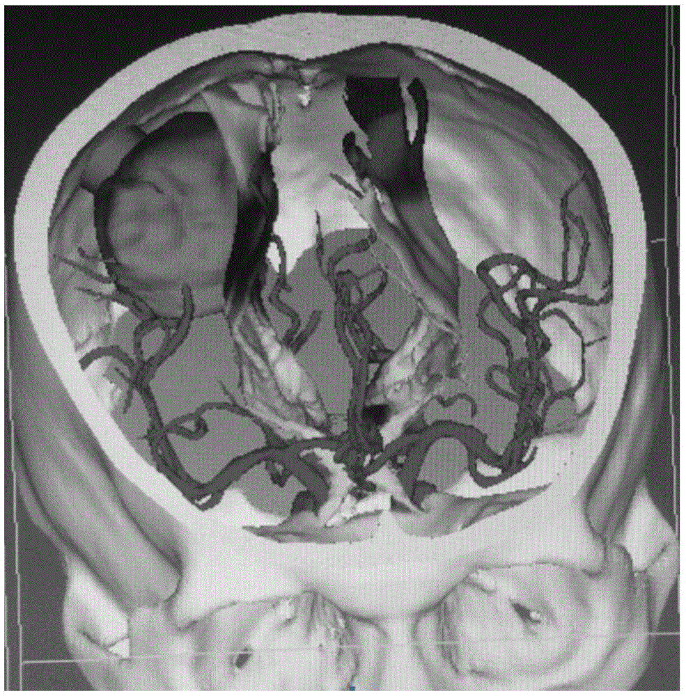 DTI (Diffusion Tensor Imaging)-based cranial nerve fiber bundle three-dimensional rebuilding method