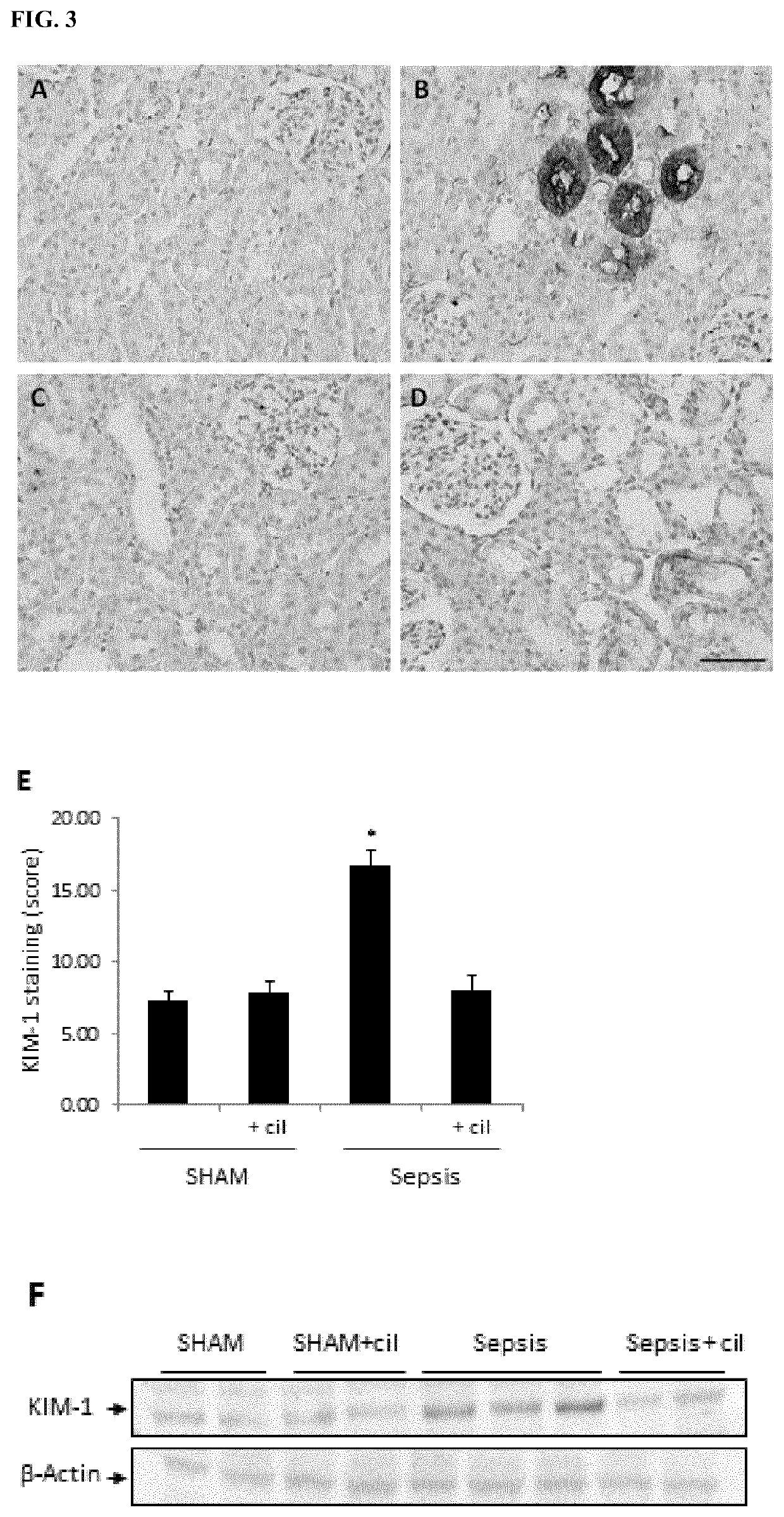 Cilastatin for use in the treatment of sepsis