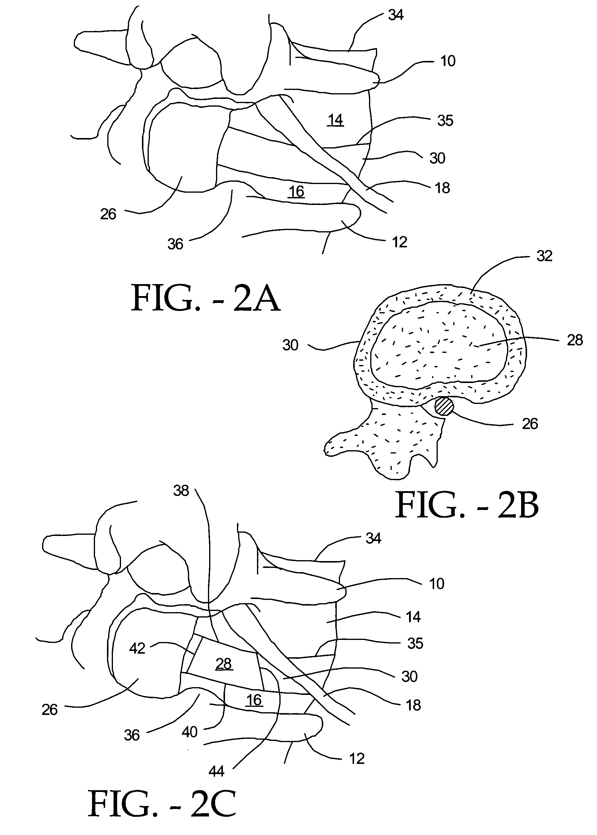 Posterior approach implant method for assembly of multi-piece artificial spinal disk replacement device in situ