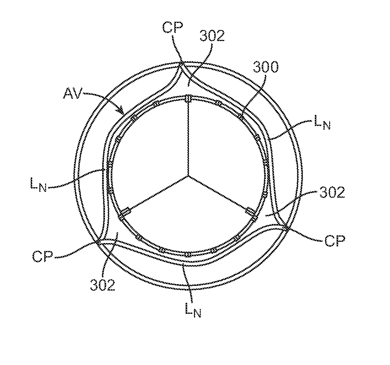 Transcatheter Valve Prosthesis Having a Variable Shaped Cross-Section for Preventing Paravalvular Leakage