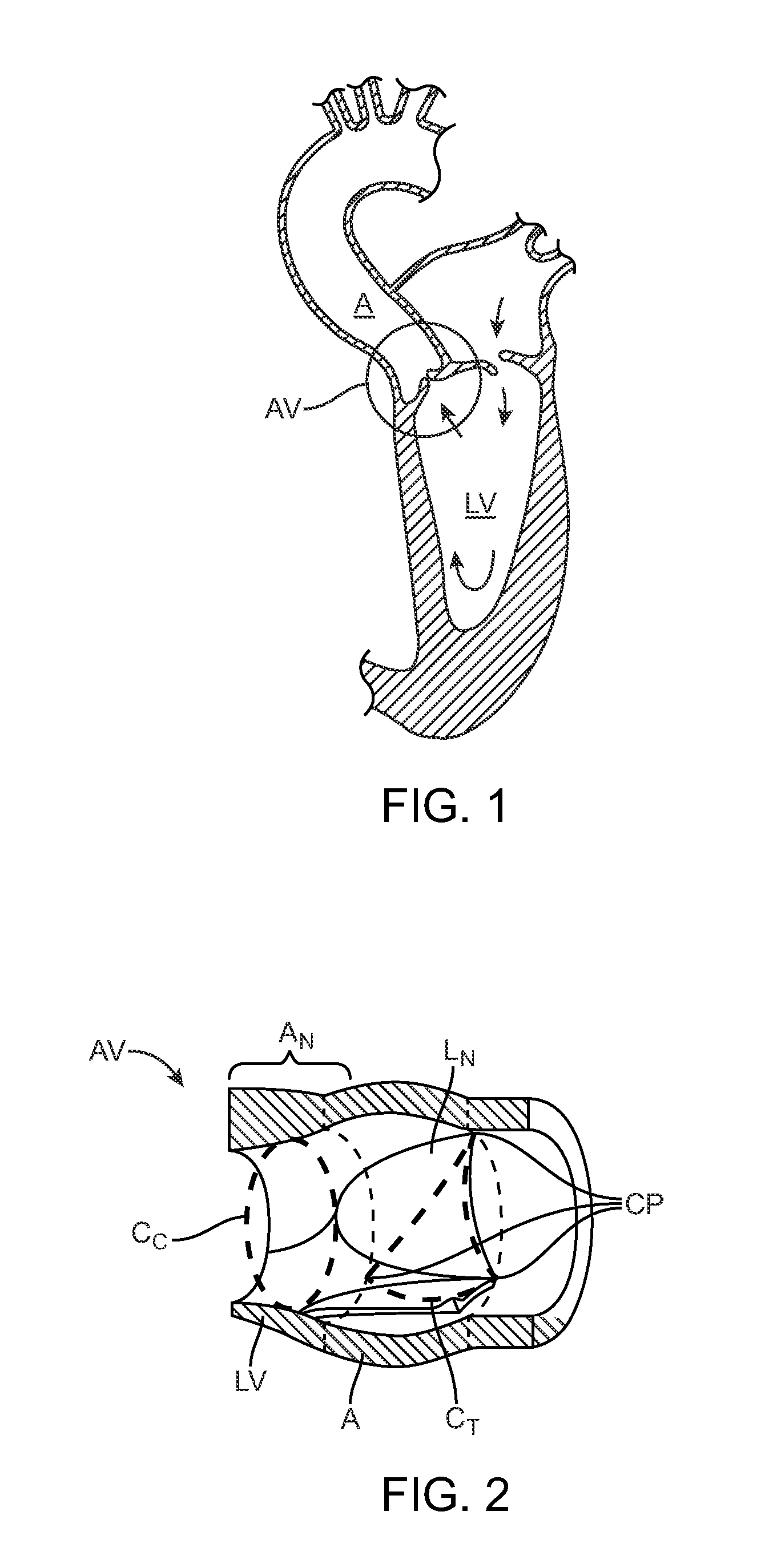 Transcatheter Valve Prosthesis Having a Variable Shaped Cross-Section for Preventing Paravalvular Leakage