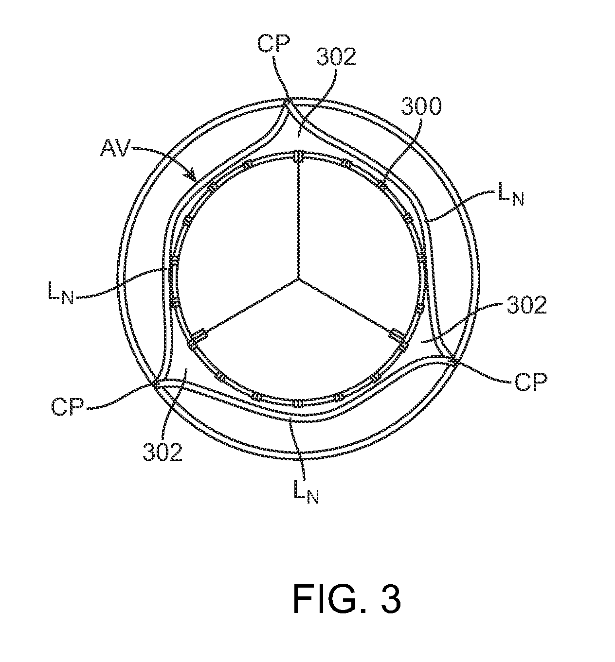 Transcatheter Valve Prosthesis Having a Variable Shaped Cross-Section for Preventing Paravalvular Leakage