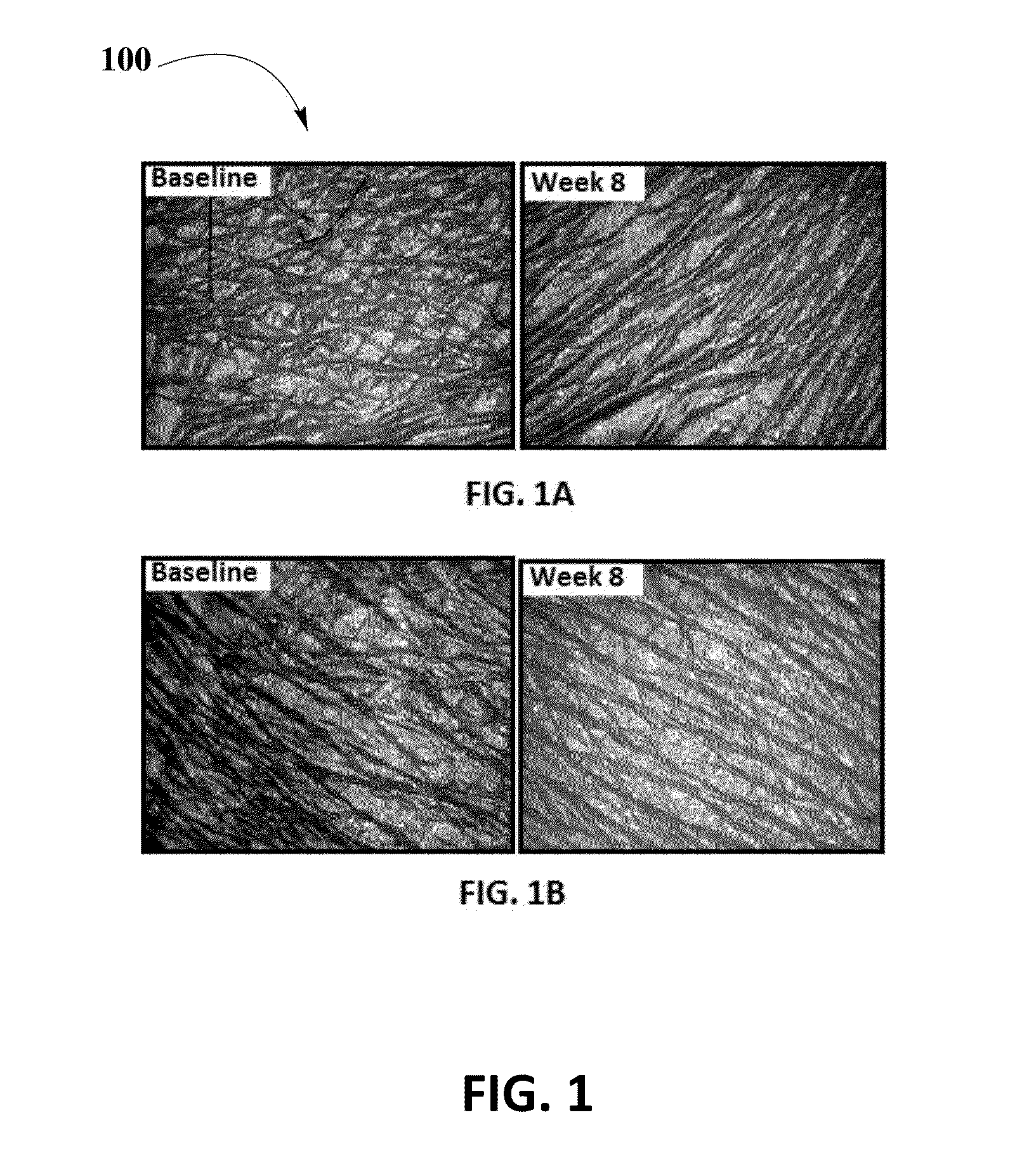 Mixture of Betamethasone and Tranilast with a Transdermal Gel for Scar Treatment