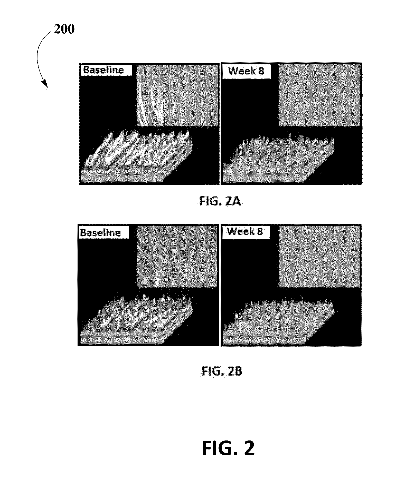 Mixture of Betamethasone and Tranilast with a Transdermal Gel for Scar Treatment