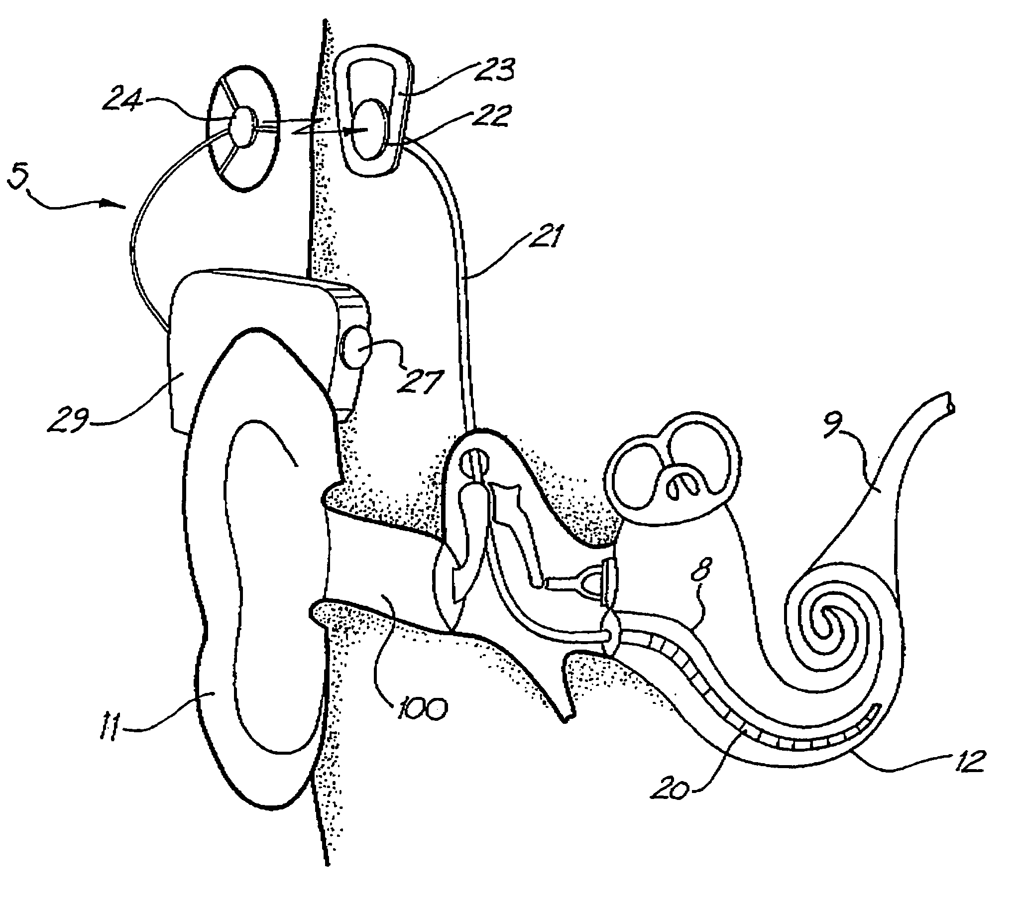 General purpose accessory for a cochlear implant system