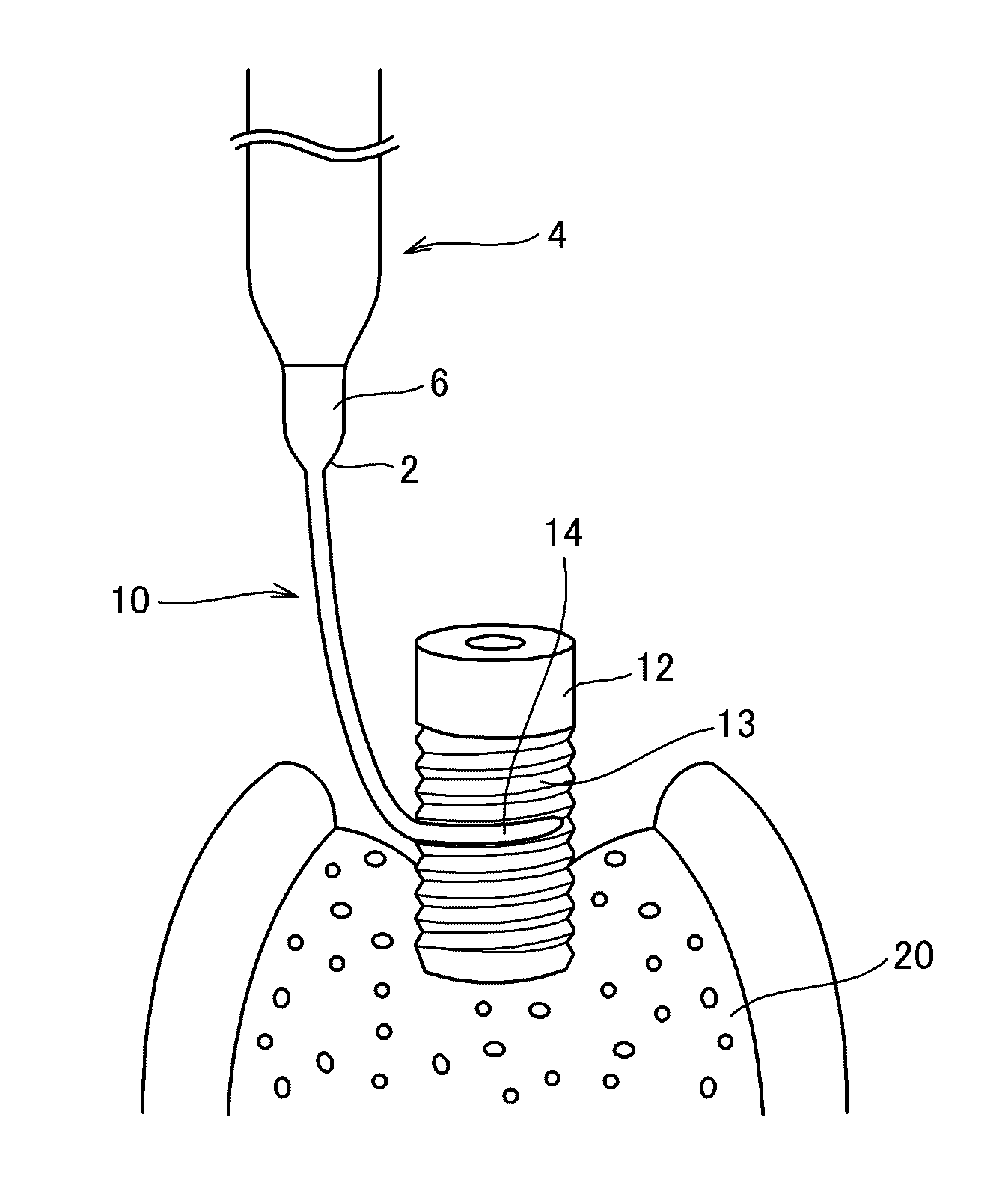 Ultrasonic scaler tip