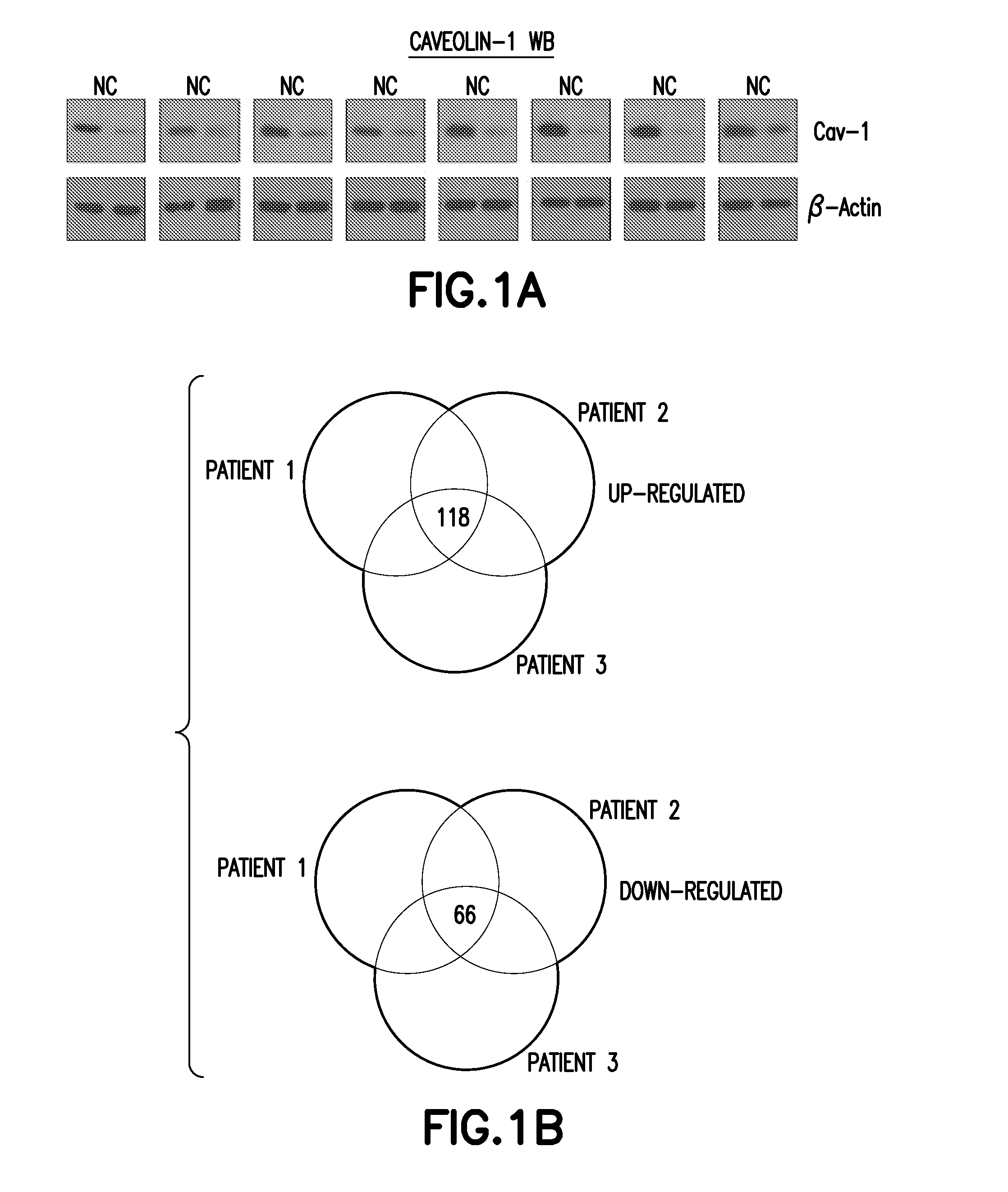 Method of Diagnosis or Prognosis of a Neoplasm Comprising Determining the Level of Expression of a Protein in Stromal Cells Adjacent to the Neoplasm