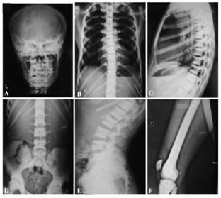 New mutation-causing gene plekhm1 in osteopetrosis, its encoded protein and its application