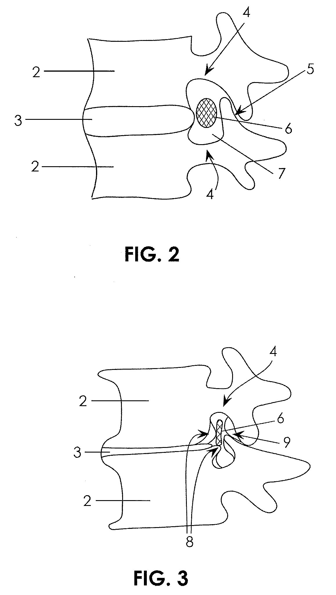 Devices and methods for measuring the space around a nerve root